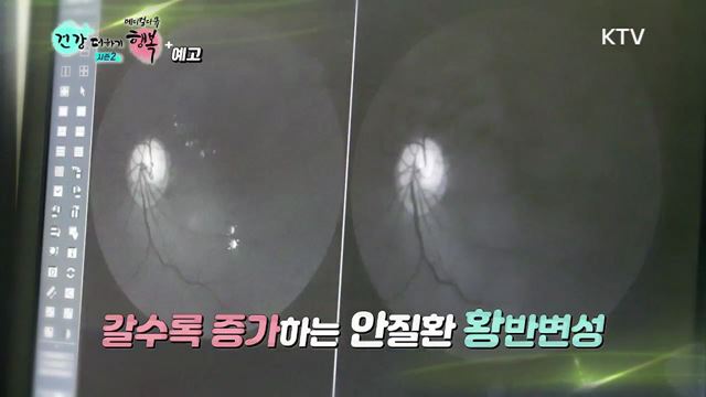 4회 예고 - 방치하면 실명 유발하는 안 질환