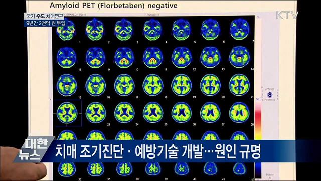 국가주도 치매연구에 9년간 2천억 원 투입