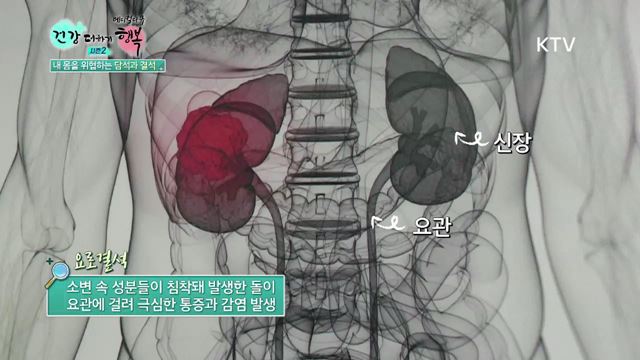 19회 하이라이트 미리보기 - 내 몸을 위협하는 담석과 결석