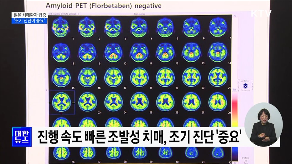 &#39;젊은 치매&#39; 조발성 치매 급증···&#34;조기 진단이 중요&#34;