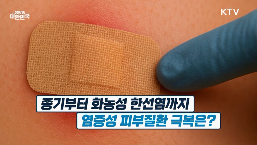 &#39;자꾸 반복되는 종기&#39; 화농성 한선염 극복법 [건강 365]