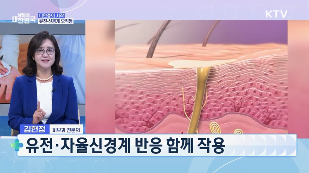 흐르는 땀의 역습! 다한증 완벽 탈출법 [건강 365]